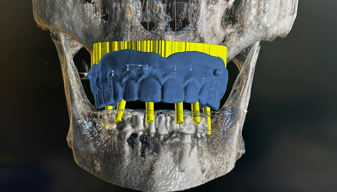 implant placement process
