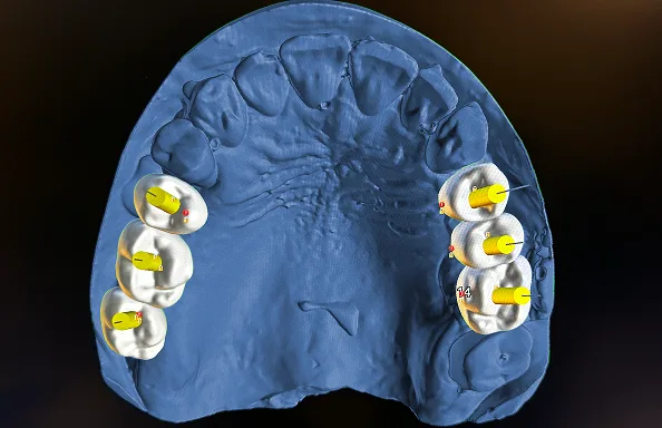 surgical guide for dental implants