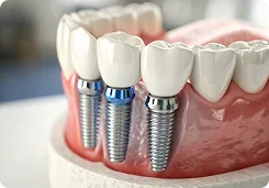 Surgical Guide for Implants