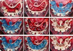 Hybrid Guides for Implant Surgical Guide