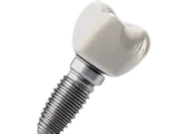 Dental Implant