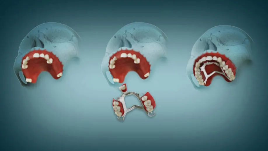 cad cam in modern surgical guide design