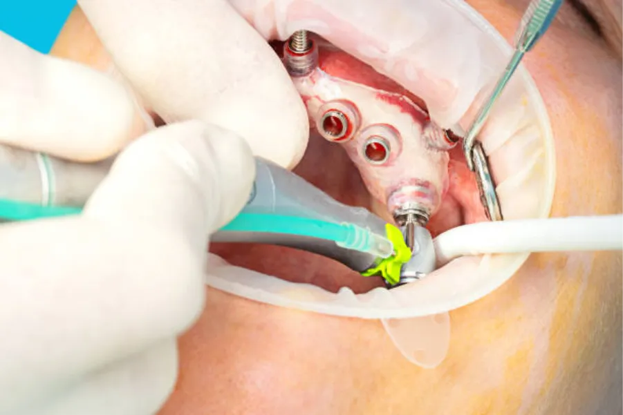 Order dental surgical guide online