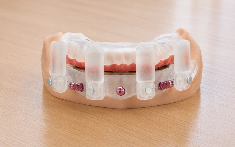 Stackable full-arch surgical guide with indexed layers and fixation pins